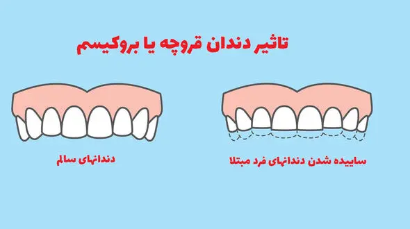 دندان قروچه شبانه چه علائمی دارد؟