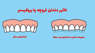 دندان قروچه شبانه چه علائمی دارد؟