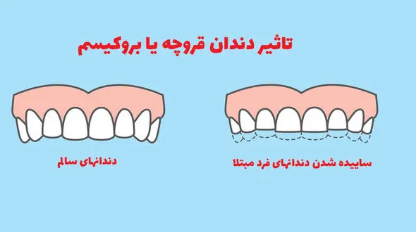 دندان قروچه شبانه چه علائمی دارد؟