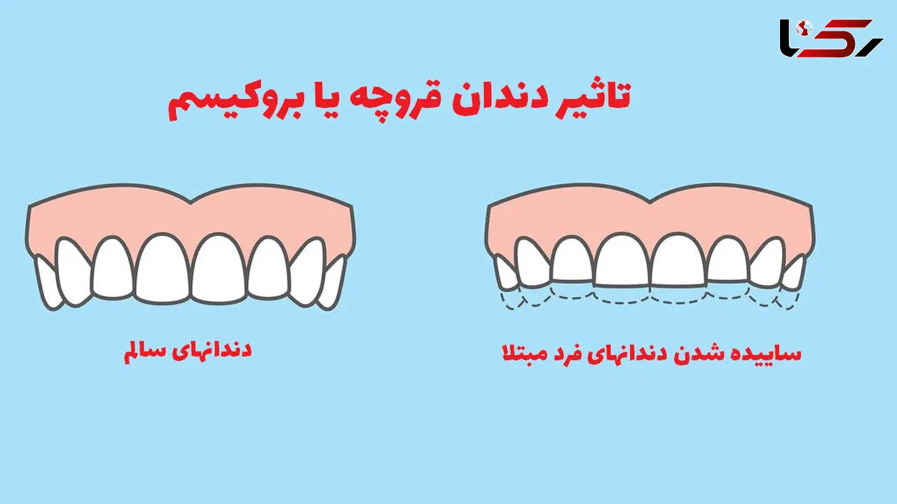 دندان قروچه شبانه چه علائمی دارد؟
