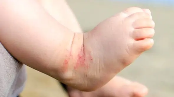 ارتباط بیماری آسم با اگزمای پوستی