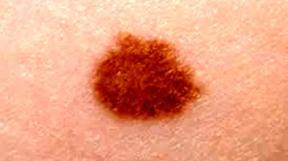 توصیه‌هایی برای جلوگیری از سرطان پوست