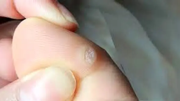 درمان میخچه با ساده ترین ترفندها