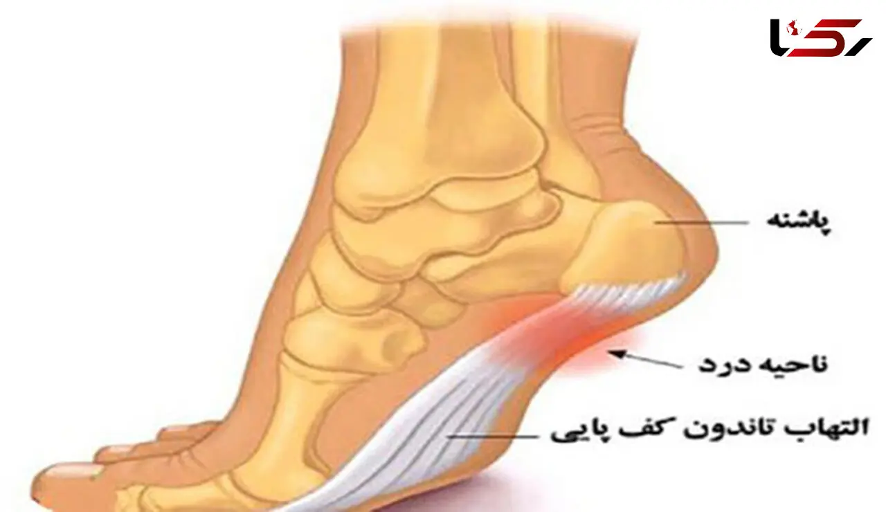 چرا به خار پاشنه مبتلا می شویم؟ 