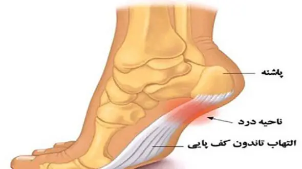 چرا به خار پاشنه مبتلا می شویم؟ 