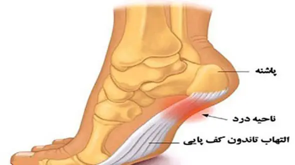چرا به خار پاشنه مبتلا می شویم؟ 