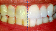 خطر ساییدگی دندان با پودرهای سفید کننده