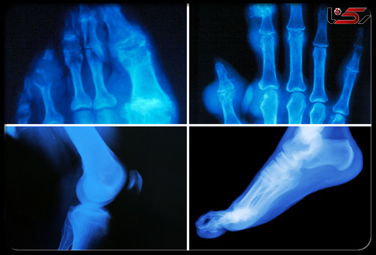 درمان نقرس پا چیست؟ + جزئیات
