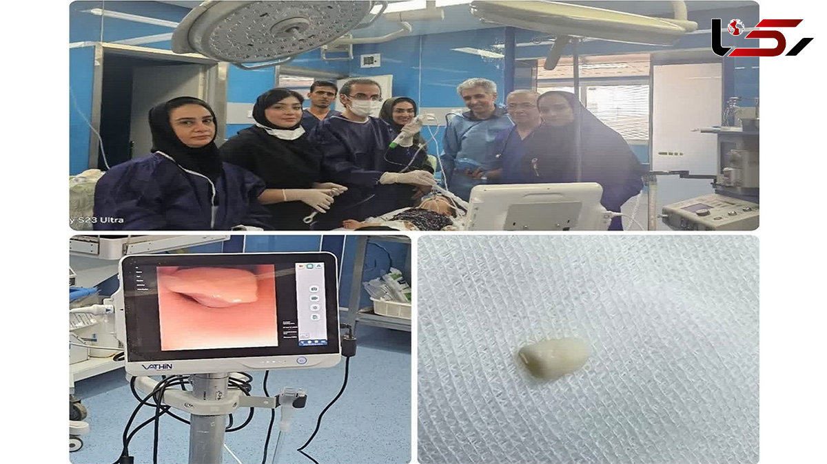 نجات شیرخوار سمنانی از خفگی با بادام زمینی