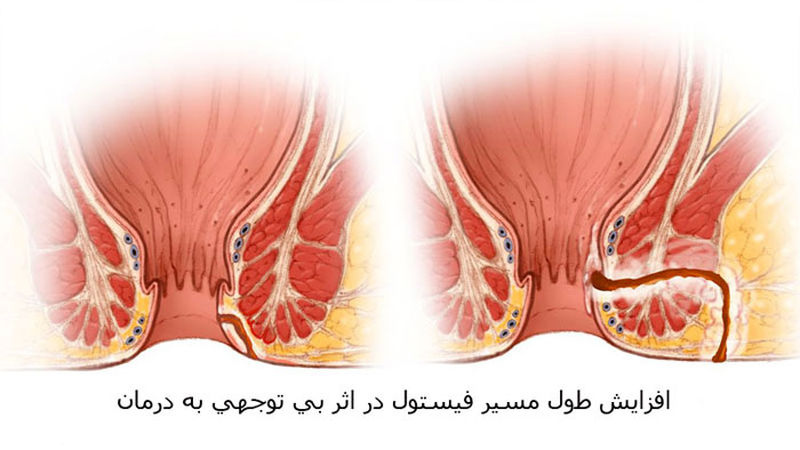 درد مخرج