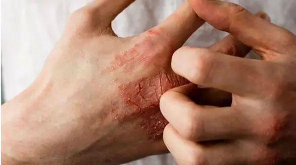 توصیه‌ های پزشکی و تغذیه ای برای رفع خشکی پوست