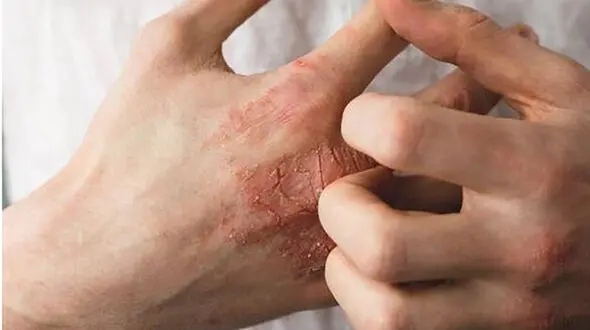 توصیه‌ های پزشکی و تغذیه ای برای رفع خشکی پوست