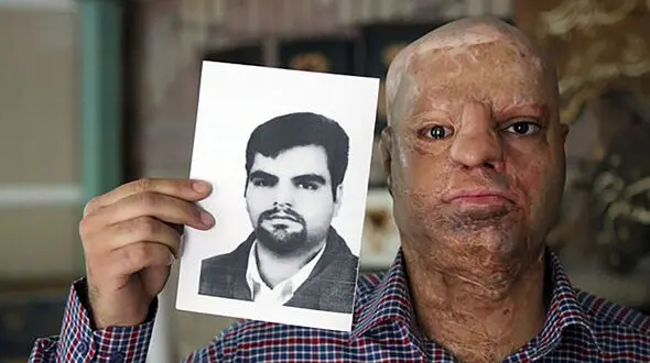 عکس قبل و بعد اسیدپاشی / گفتگو با محسن که با اسید سوخت