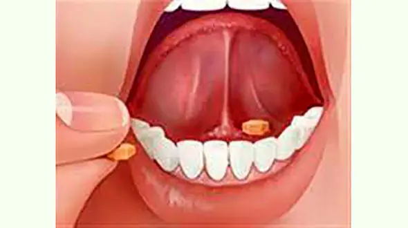 قرص زیر زبانی چیست ؟