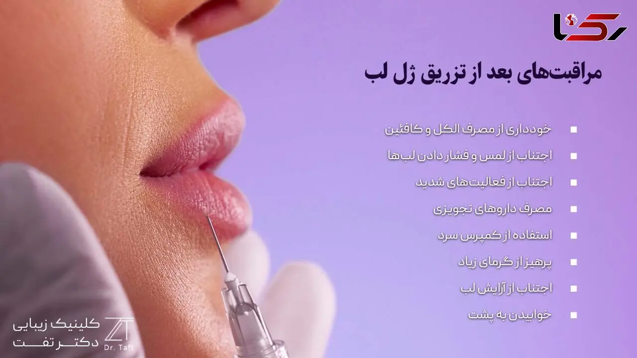 مراقبت‌های بعد از تزریق ژل لب