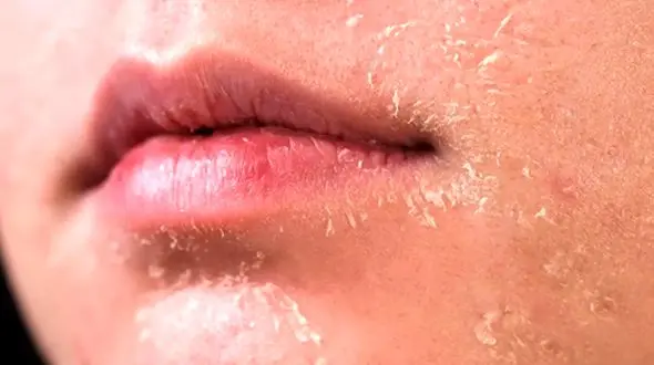 ویتامین‌ های ضروری برای پیشگیری از خشکی پوست صورت