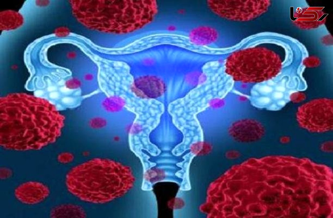 خطر سندرم تخمدان پلی کیستیک زنان مسن را تهدید می کند