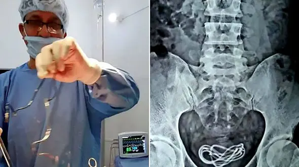 خارج کردن سیم شارژر از مثانه یک مرد ! + عکس / هند