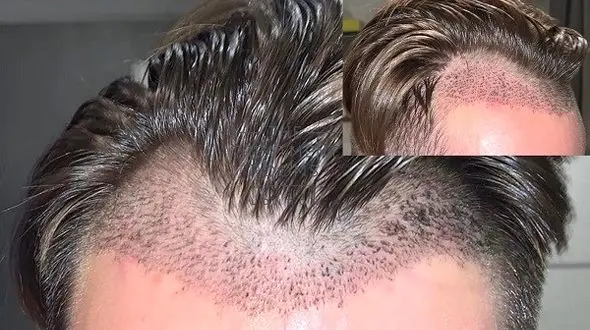 همه چیز درباره کاشت مو