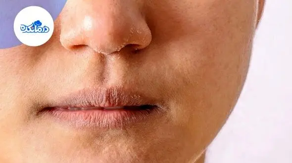 خشکی پوست در پاییز و راه‌های درمان آن