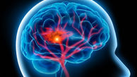 چگونه می توان از بروز سکته مغزی جلوگیری کرد