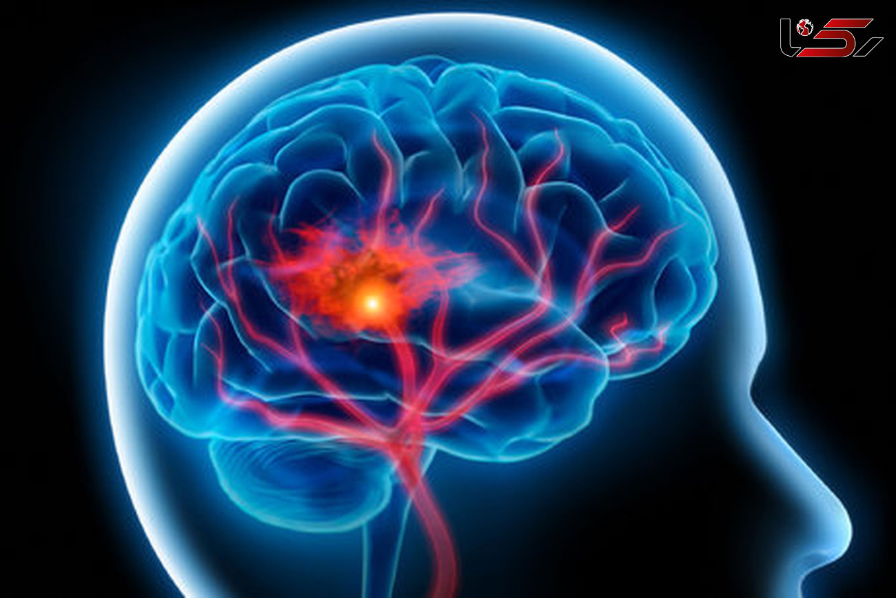 چگونه می توان از بروز سکته مغزی جلوگیری کرد
