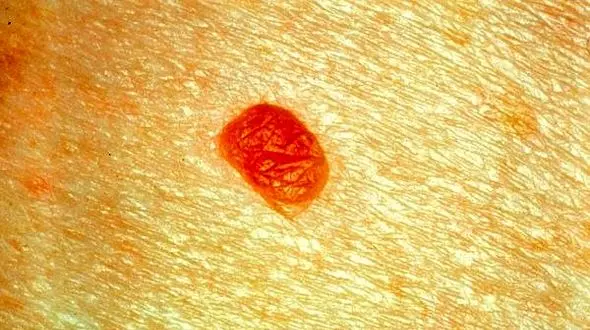 سرطان پوست نشانه ابتلا به انواع سرطان هاست