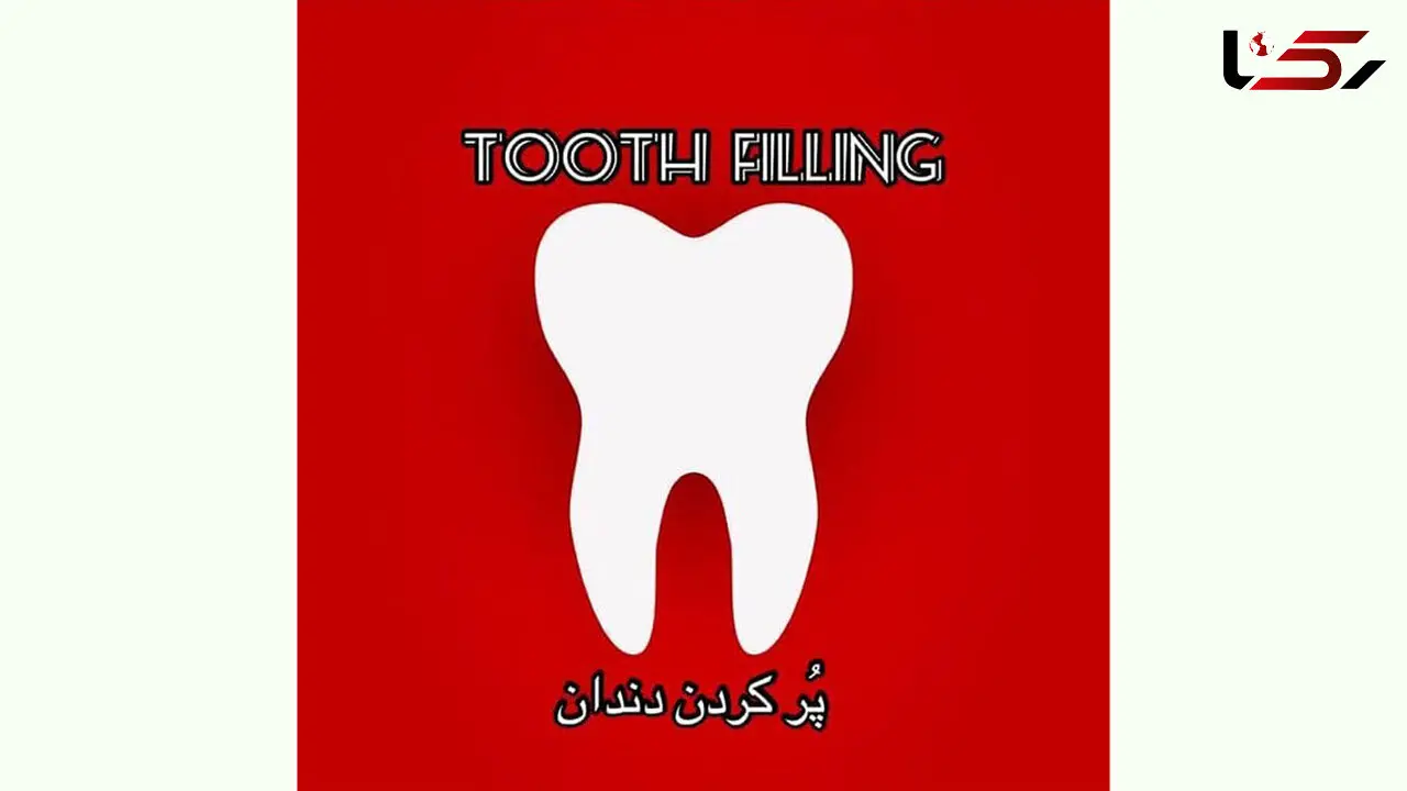 پر کردن دندان با آمالگام (amalgam) + فیلم 