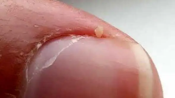 علت ریشه شدن کنار ناخن ها چیست؟