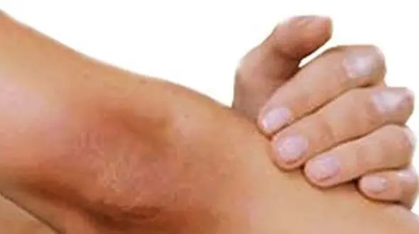 درمان تیرگی زانو‌ و آرنج با طب سنتی