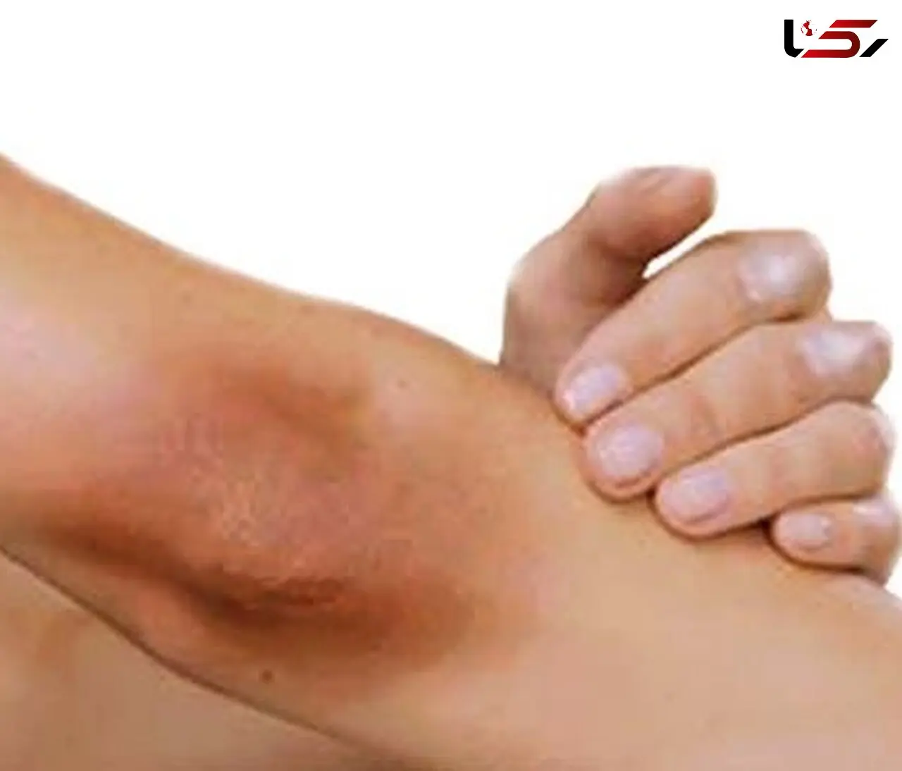 درمان تیرگی زانو‌ و آرنج با طب سنتی