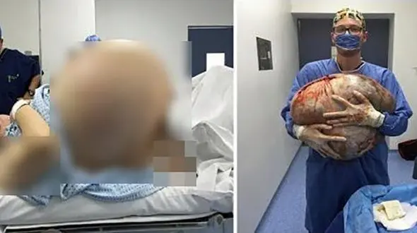 خارج کردن تومور 60 کیلیویی از شکم یک بیمار + عکس 