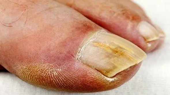 نشانه های قارچ ناخن