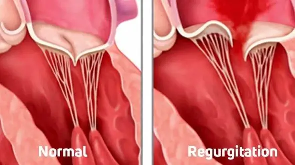 نقش سروتونین در تشدید بیماری دریچه قلب