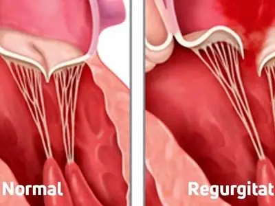 نقش سروتونین در تشدید بیماری دریچه قلب