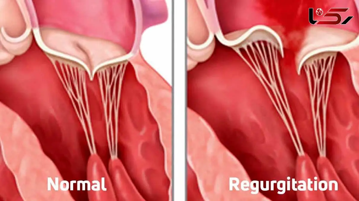 نقش سروتونین در تشدید بیماری دریچه قلب