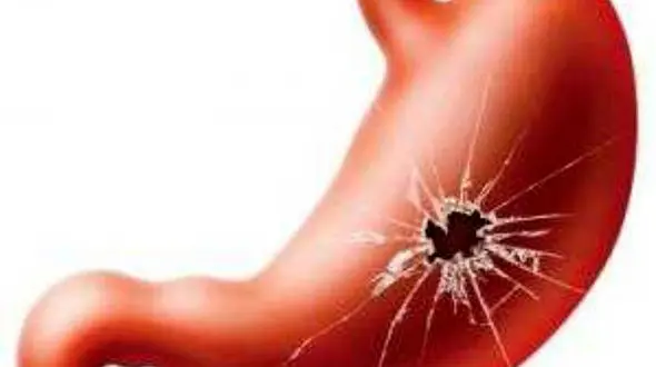 از کجا بفهمیم زخم معده گرفته ایم؟