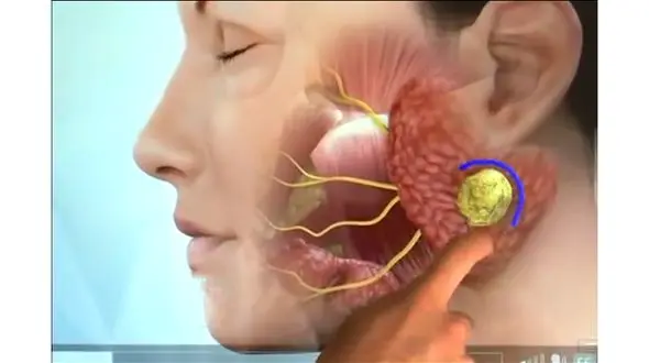 هشدار به افراد بالای 40  سال / مراقب تومور  غدد بزاقی باشند
