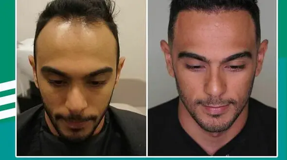 روش‌های جوانسازی و پاکسازی صورت