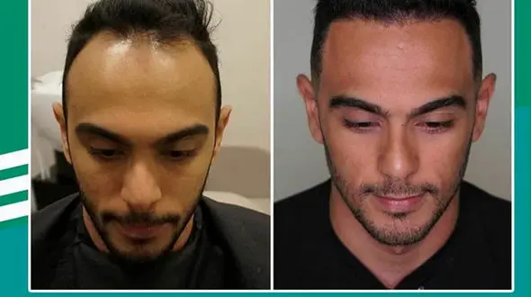 روش‌های جوانسازی و پاکسازی صورت