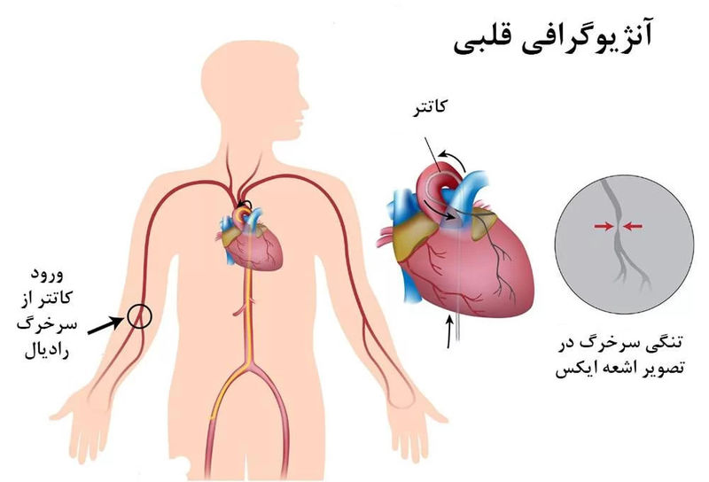 آنژیوگرافی قلبی