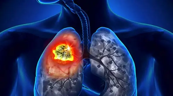 علت‌ های اصلی سرطان ریه در ایران بر اساس مطالعات علمی