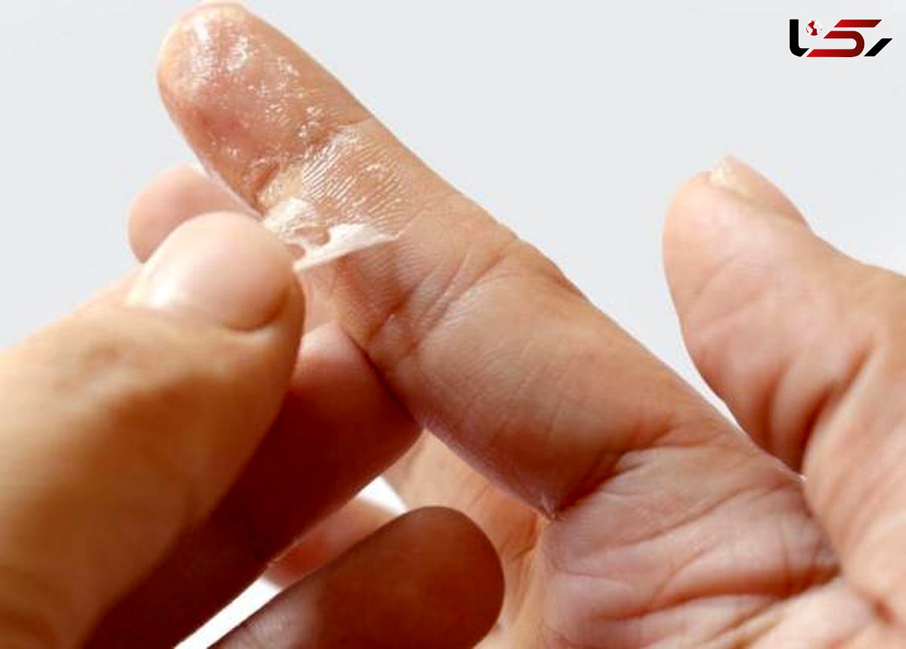 ترفندهای پاک کردن چسب قطره ای از روی پوست