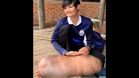 نیش پشه پای پسری را 5 برابر کرد / او درمان نمی شود + عکس باورنکردنی