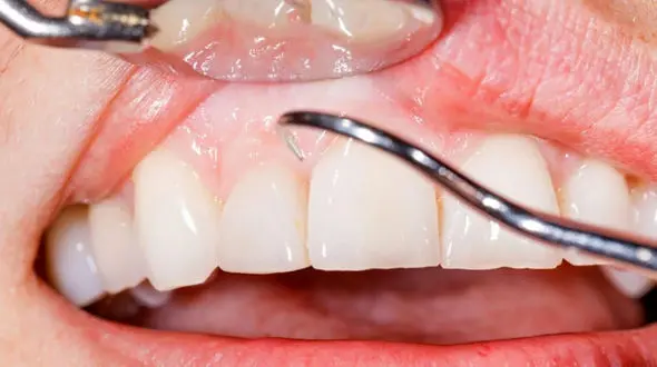 راهکارهای سالم نگه داشتن لثه