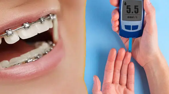 آیا افراد دیابتی می توانند ارتودنسی دندان انجام دهند؟