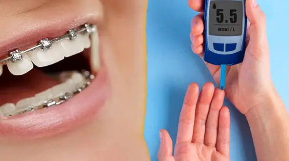 آیا افراد دیابتی می توانند ارتودنسی دندان انجام دهند؟
