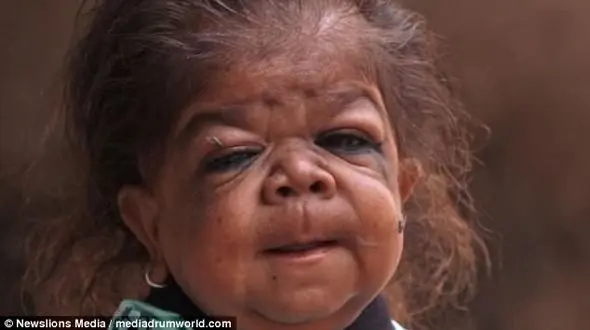 بیماری نادر این جوان 23 ساله، او را شبیه کودک یک ساله کرده است +فیلم +تصاویر