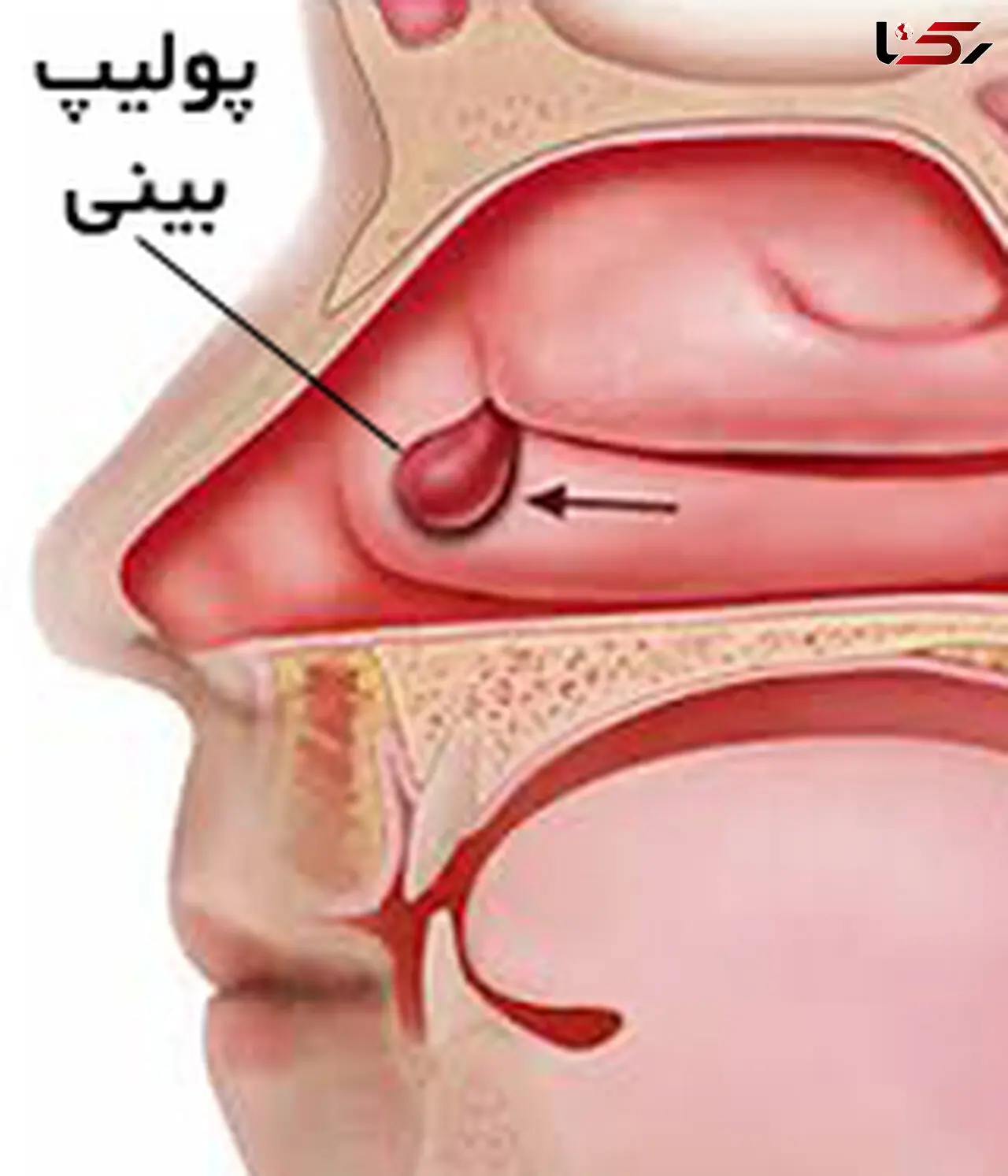 درمان های پولیپ بینی