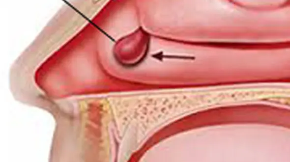 درمان های پولیپ بینی